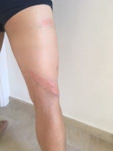 Bruises on Mattias' leg
