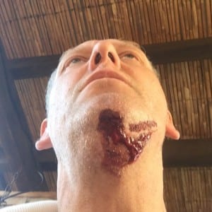 Paul was bitten on his neck