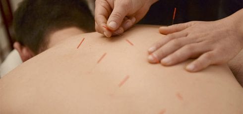 acupuncture