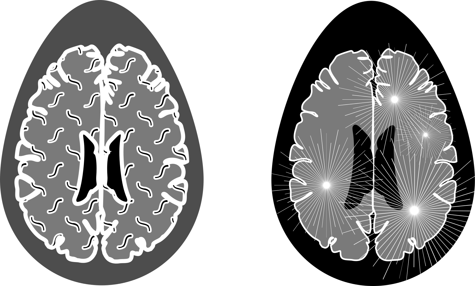 Multiplesclerosis